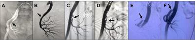 Diagnostic and therapeutic strategies for vascular complications after renal transplantation: a single-center experience in 2,304 renal transplantations